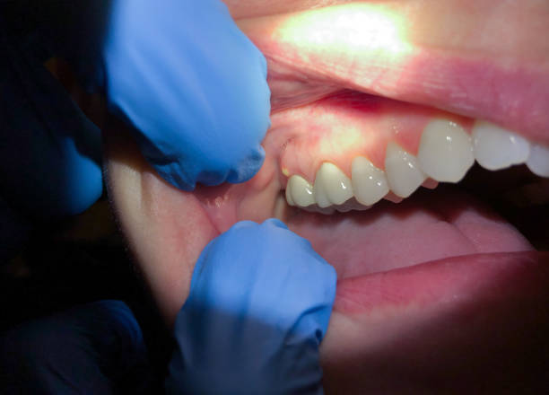 Best Emergency Dentist for Knocked-Out Tooth in Bloomfield, NY